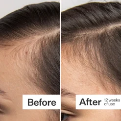 Act+Acre Scalp Dermaroller 0.25mm