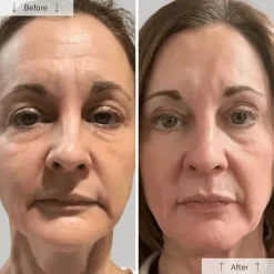 OMNILUX Contour LED Face Mask