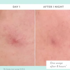 Patchology S.O.S. Totally-Invisible Clarifying Liquid Patch