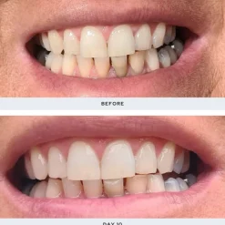 Spotlight Oral Care Professional LED Teeth Whitening System