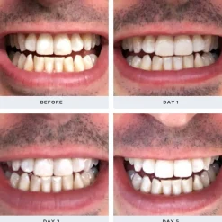 Spotlight Oral Care Professional LED Teeth Whitening System